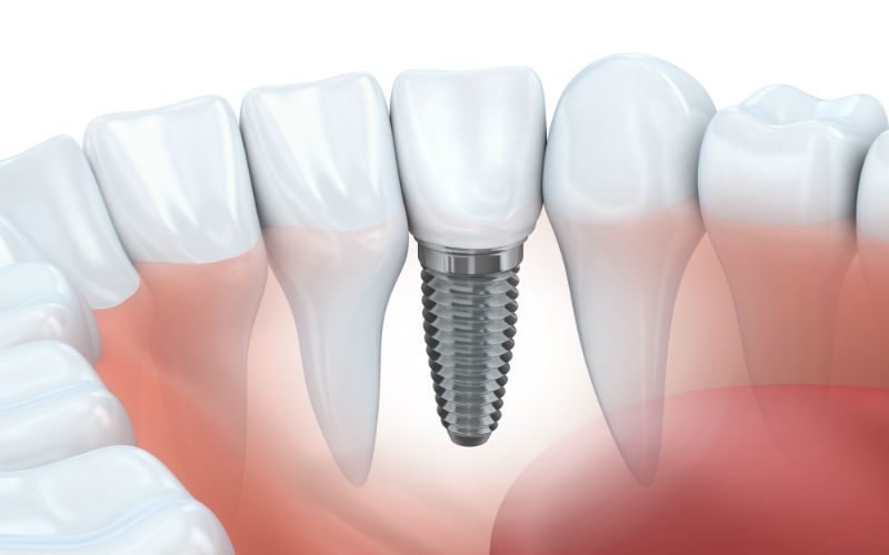 How Dental Implants in Philadelphia, PA, Improve Your Appearance