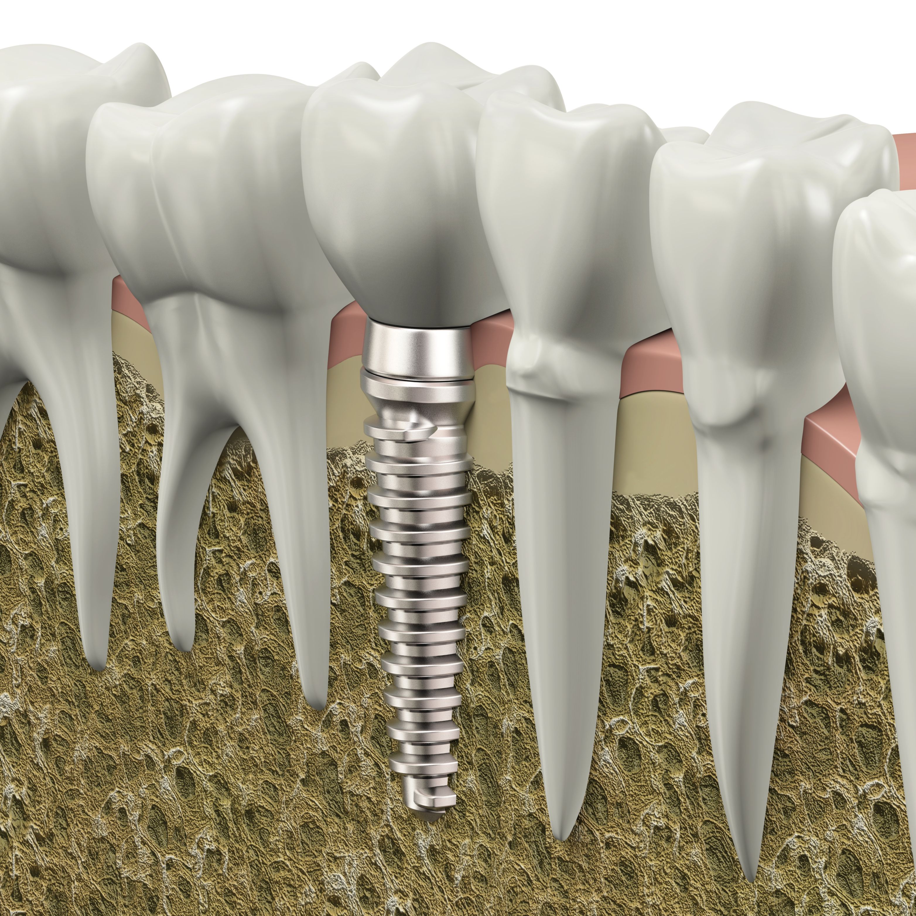 What to Expect After the Dental Implants in Cranford, NJ Are In Place