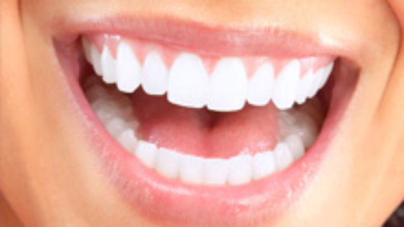 Determining Whether You’re a Good Candidate for Teeth Whitening in Del City, OK