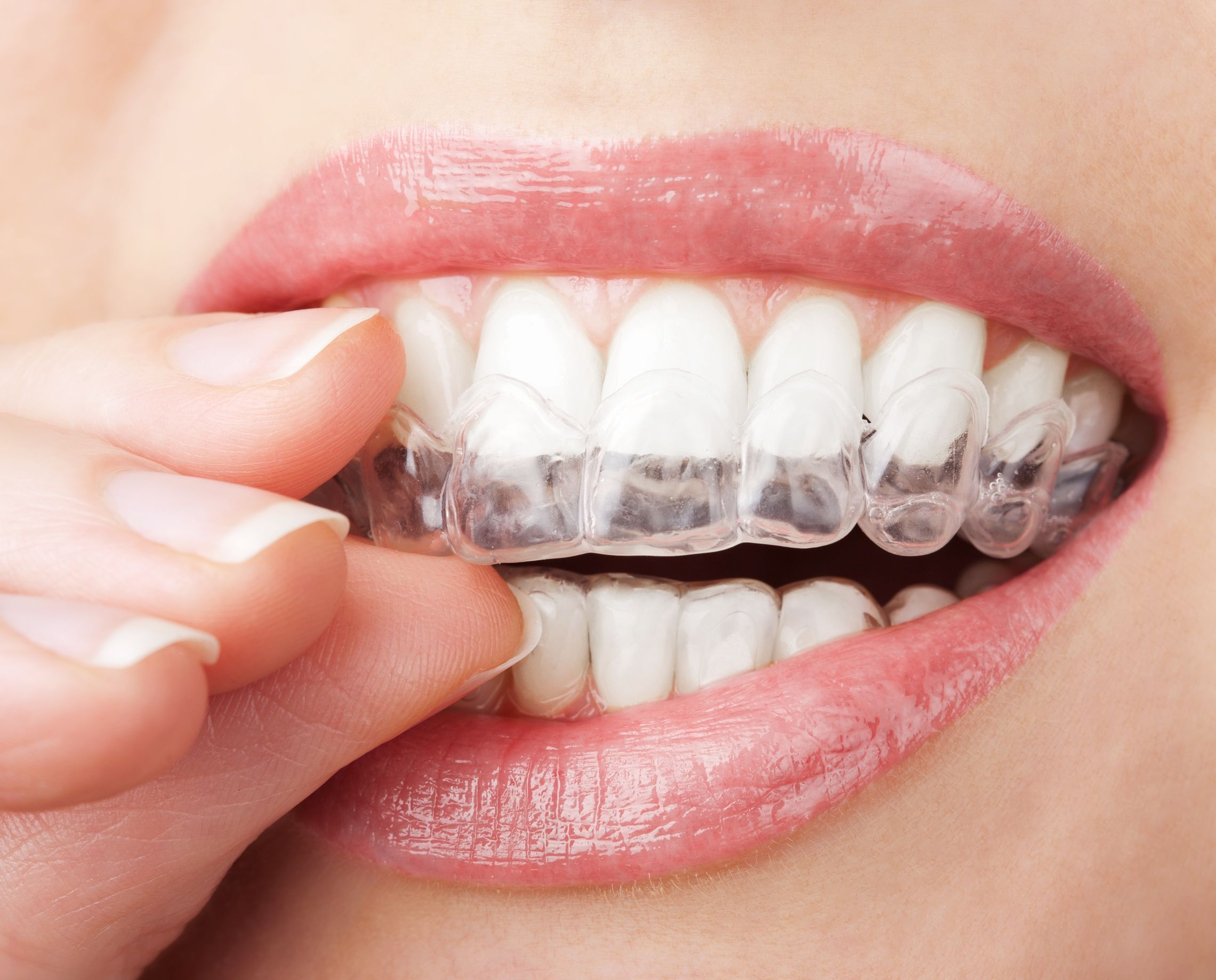 The Benefits of Invisalign in Annapolis