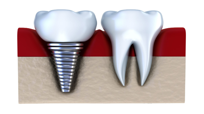 Dental Implants In Adelaide: The Benefits