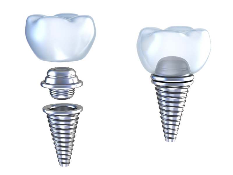 Dental Implants In Castle Hill: Benefits