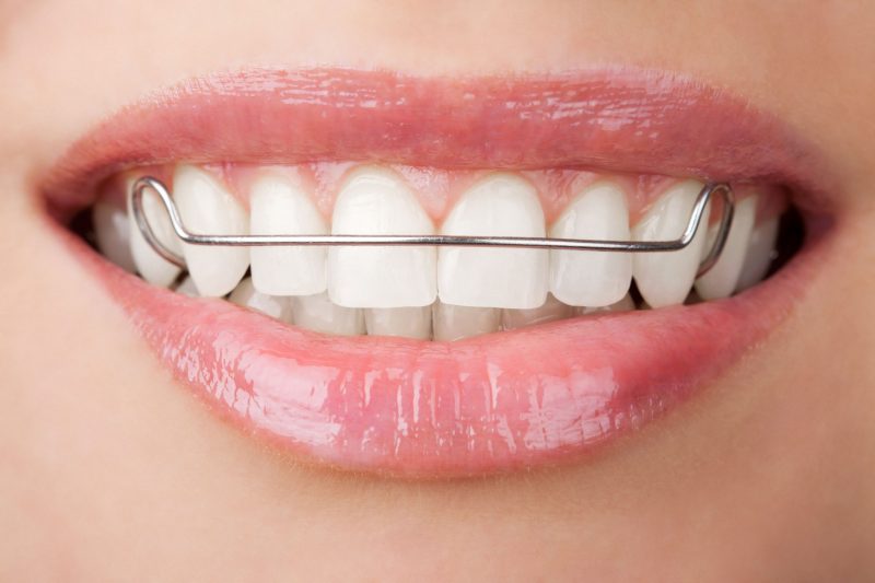 Invisalign for Comfort, Convenience and a Straighter Smile