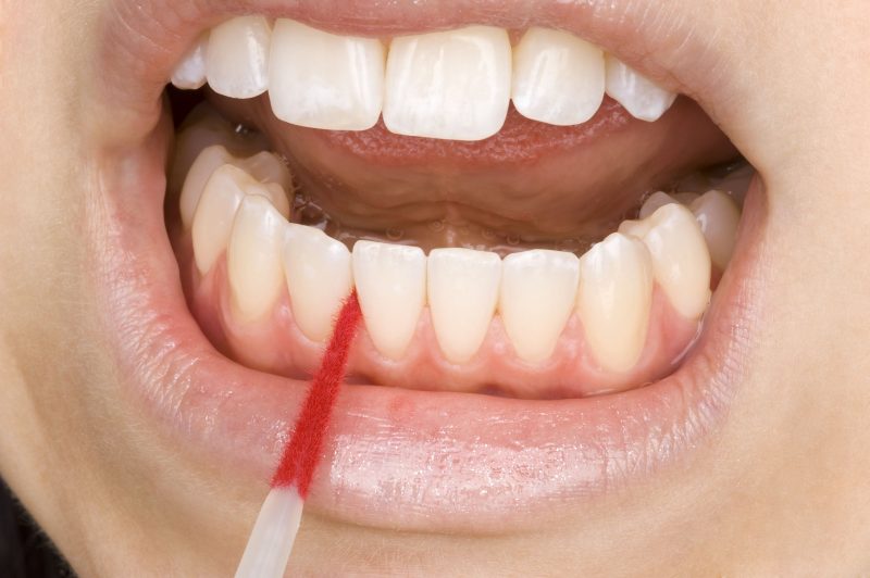 Protect Yourself against Gum Recession in Plainville, CT