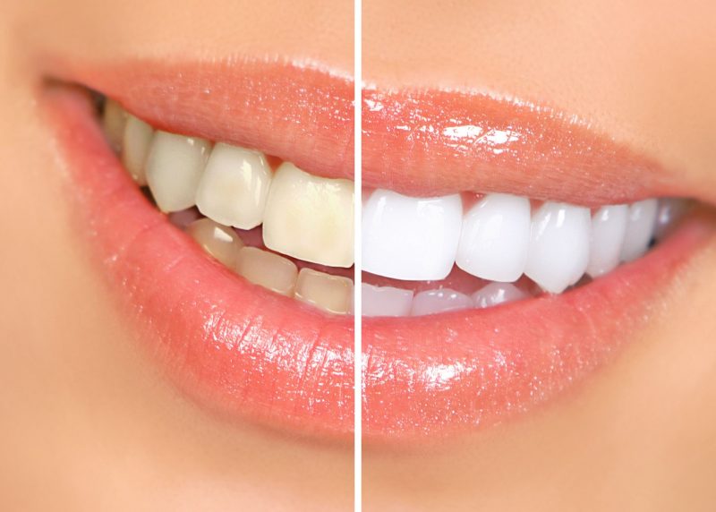 Benefits of Porcelain Veneers in O’Fallon, MO