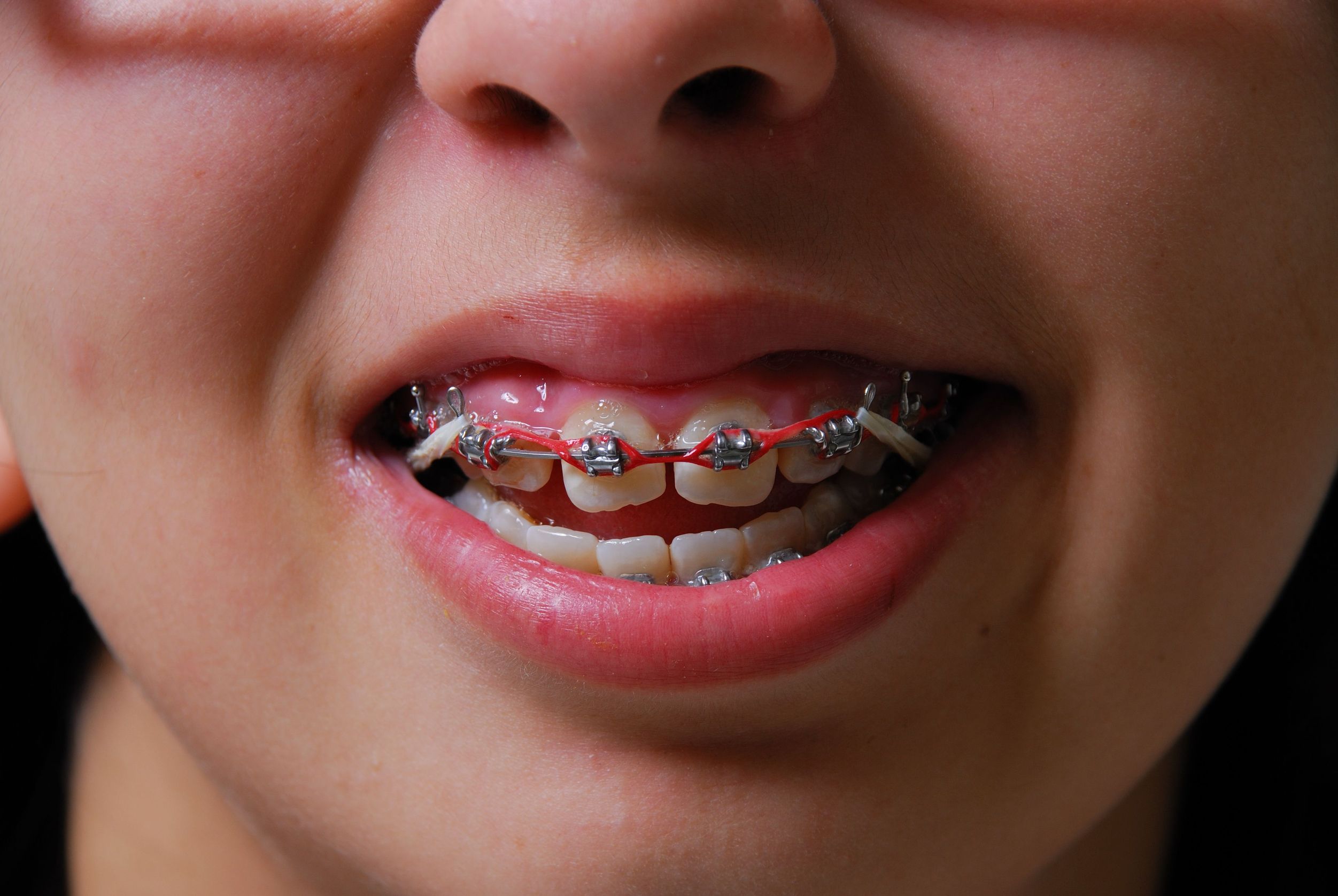 A Look at the Comprehensive Orthodontic Services in Medina, OH