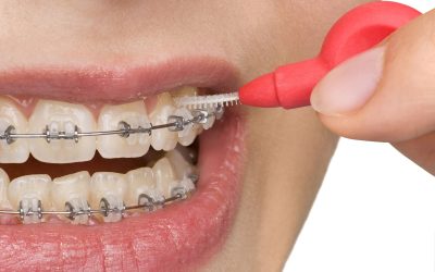 4 Crowded Teeth Treatment Options From an Orthodontist in Oxnard, CA