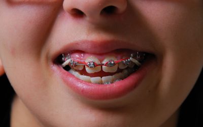 The Advantages Of Orthodontics For Adults In Medina OH